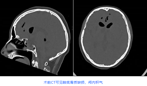 术前CT可见鞍底骨质缺损，颅内积气
