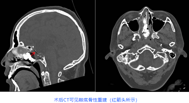 术后CT可见鞍底骨性重建(红箭头所示)