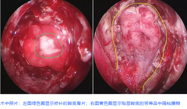 术中照片：左图绿色圈显示修补的鞍底骨片;右图黄色圈显示贴覆鞍底的带蒂鼻中隔粘膜瓣