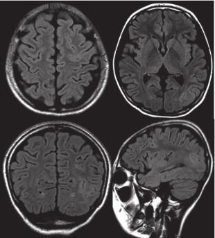 图 2. 患者头颅 MRI：左顶枕及左额叶皮层异常信号。