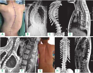 A: 术前大体像 B：术前立位平片 C：术前三 维 CT 重建 D：术前 MRI 矢状位 E：术前 MRI 冠状位 F：术前 MRI 胸段 G: 术后大体像 H： 术后三维 CT 重建 I：术后 MRI 矢状位