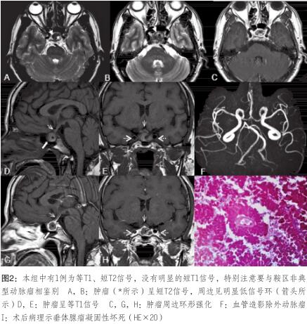 与鞍区非典 型动脉瘤相鉴别
