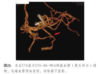 术后CTA