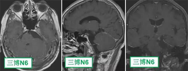 术后MRI