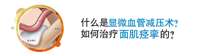 显微血管减压术如何治疗面肌痉挛？