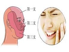 三叉神经痛