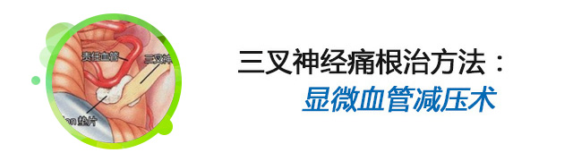 三叉神经痛和偏头痛