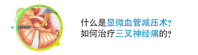 什么是显微血管减压术，如何治疗三叉神经痛？