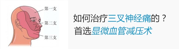 怎么治疗三叉神经痛？