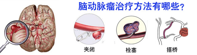 脑动脉瘤到底如何治疗好？