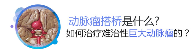 脑动脉瘤怎么治疗？脑动脉瘤治疗方法有哪些？