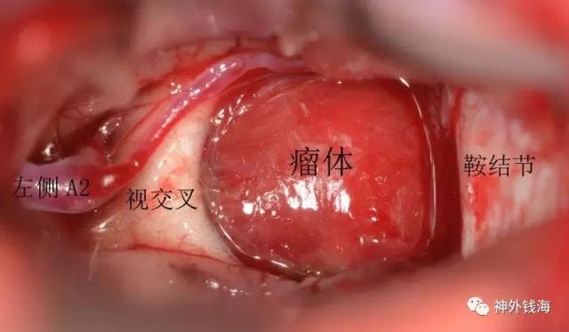 颅咽管瘤术后患者的激素减量经验