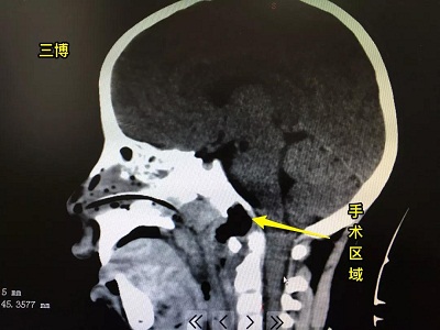 童童术后影像