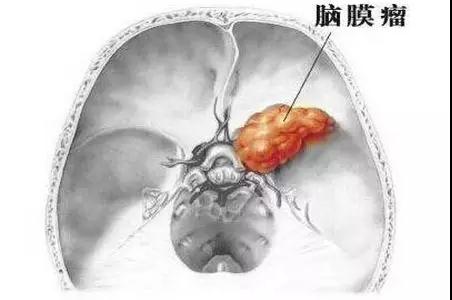 脑膜瘤