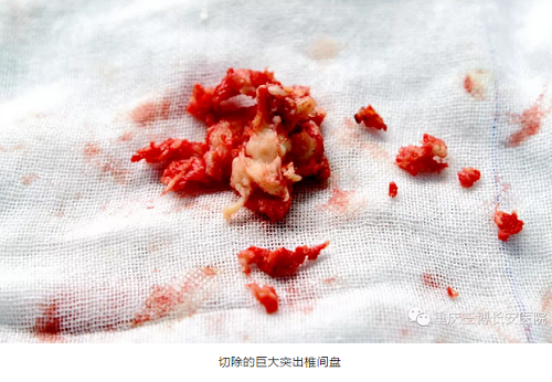 切除的巨大突出椎间盘