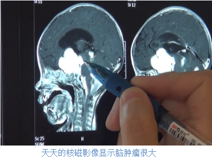 天天的核磁影像显示脑肿瘤很大