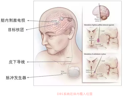 脑起搏器