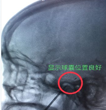 X光下可见黑色显影导管位置良好