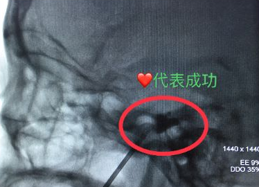 X光下可见黑色显影扩张的球囊