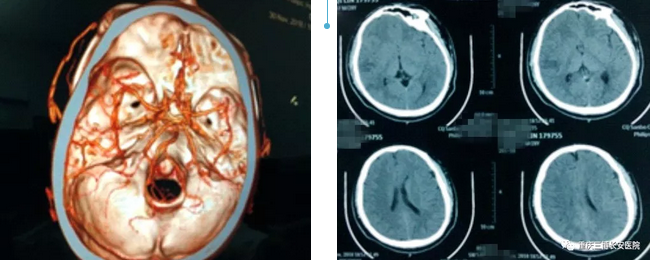 急诊CT+CTA证实邓先生发生急性脑梗死