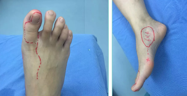 两次手术，“移花接木”再造拇指！