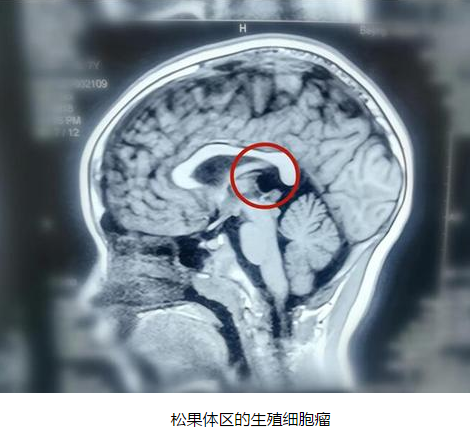 孩子出现性早熟现象 家长警惕脑瘤作怪