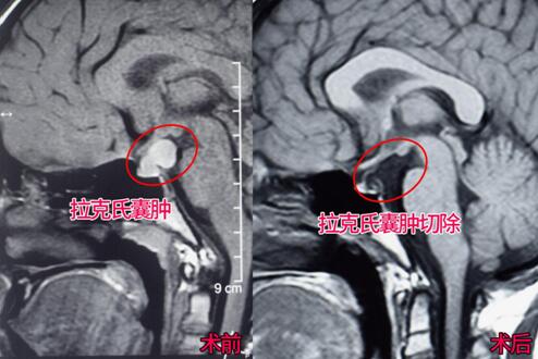 孩子身体矮小、发育迟缓 可能是颅内里长了东西
