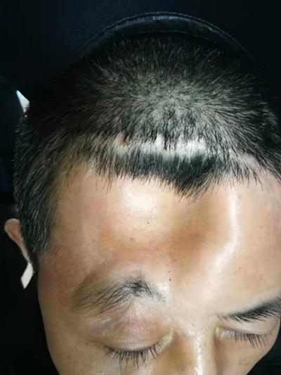 右额骨和眉弓粉碎性骨折 右前额出现大坑怎么办