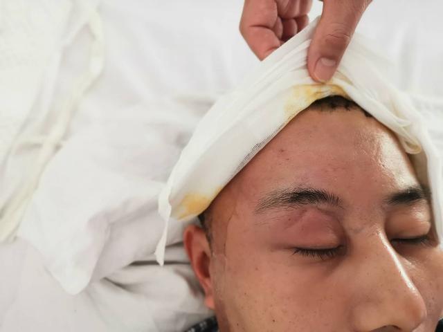 右额骨和眉弓粉碎性骨折 右前额出现大坑怎么办