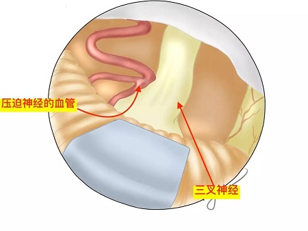 三叉神经压迫血管示意图