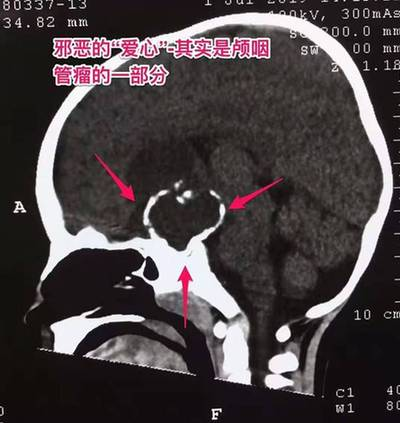 3岁男童身高比同龄矮一头 没想到是脑肿瘤捣乱