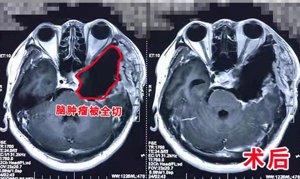 46岁男子脑肿瘤包裹大血管 先搭桥后切肿瘤同期手术救患者