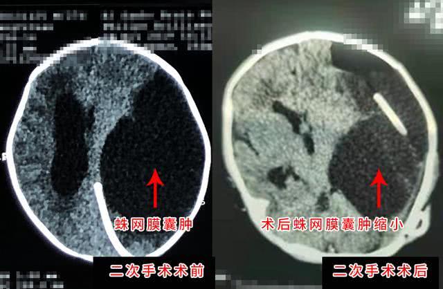 29天婴儿巨大蛛网膜囊肿 三博脑科精准手术疏通“水”路 29天婴儿巨大蛛网膜囊肿 三博脑科精准手术疏通“水”路