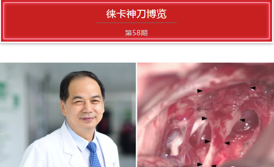 神刀博览| 三博脑科闫长祥: 枕下乙状窦后入路切除听神经瘤 如何处理三个难点 - 手术视频及讲解