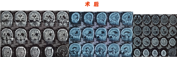 3岁有斗鸡眼，父母忽视，13岁发现巨大脑肿瘤，这些症状需警惕!