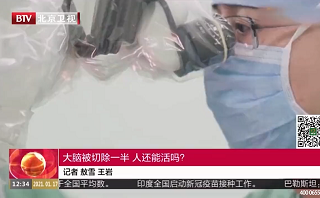 癫痫患者，大脑被切除一般还能活<