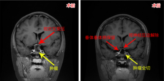 医生妈妈:我要给我孩子找最好的颅咽管瘤手术团队 医生妈妈:我要给我孩子找最好的颅咽管瘤手术团队