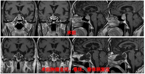  高龄是脑外科手术禁忌？三博脑科医院86岁脑肿瘤患者术后3天顺利出院